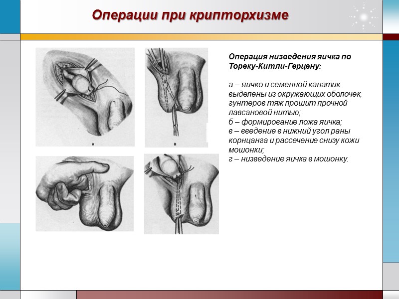 Операции при крипторхизме Операция низведения яичка по Тореку-Китли-Герцену:  а – яичко и семенной